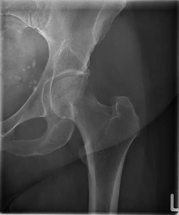 TRB 9020Hで撮影した大腿骨レントゲン写真