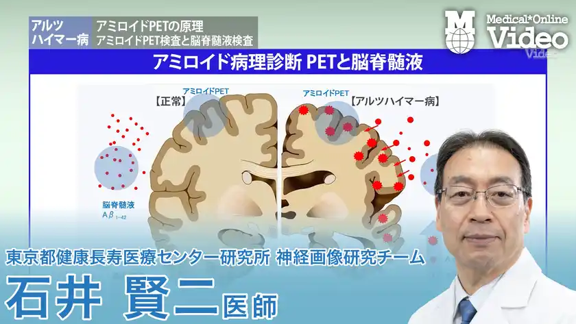 アルツハイマー病 アミロイドPETの原理 ガイドライン概要