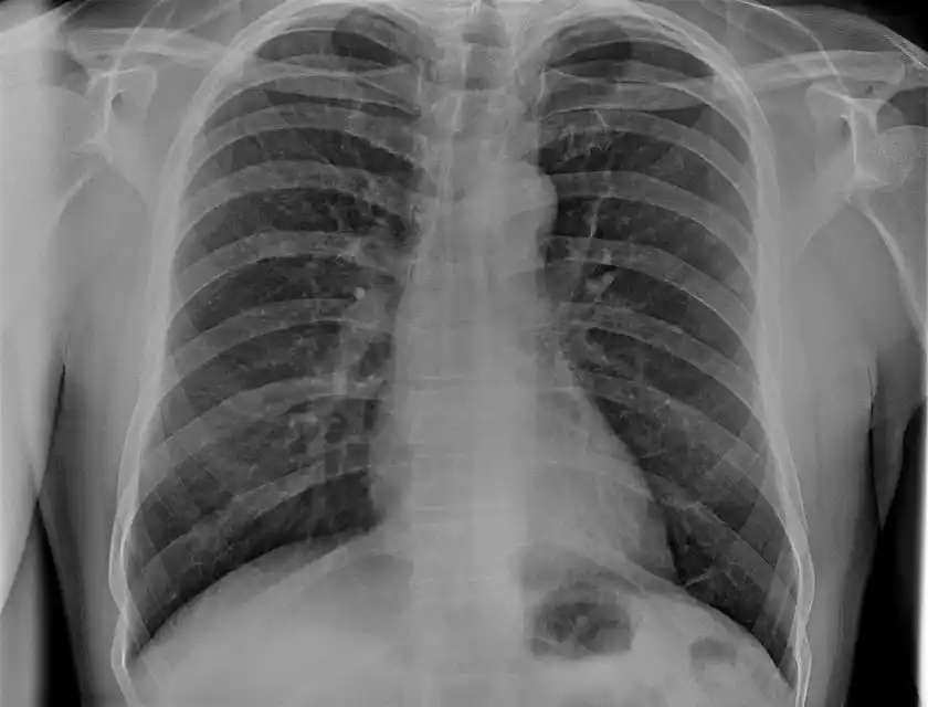 TRB 9020Hで撮影した胸部レントゲン写真