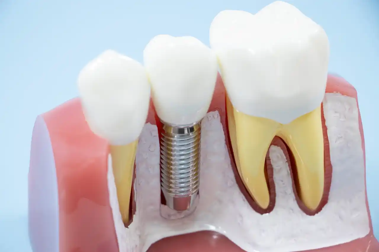 「抜歯してインプラントしか無い」と言われた方へ。その歯、本当に抜く必要がありますか？丘の上歯科醫院からのご提案