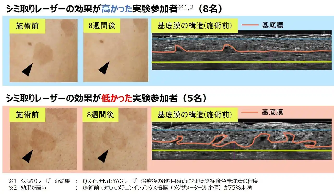 【株式会社コーセー】 シミ取りレーザーの効果が 表皮の基底膜の凸凹度合いで変わることを発見