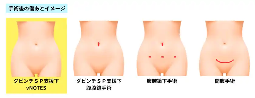 従来手術と比較した創部イメージ(vNOTESでは腹部に傷が残らない)