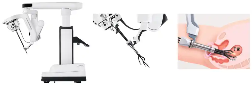単孔式手術支援ロボット「da Vinci SP Surgical System」による手術イメージ