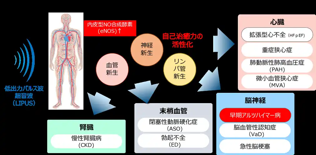 【住友重機械工業株式会社】 早期アルツハイマー病治療装置の研究開発を手掛けるサウンドウェーブイノベーションへの出資および業務提携契約の締結